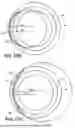 Fig. 13 - INTRAOCULAR IMPLANTS AND RELATED KITS AND METHODS