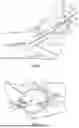 Fig. 05 - SUTURE LOCKING DEVICES FOR PERFORMING TENSIONABLE KNOTLESS SURGICAL PROCEDURES