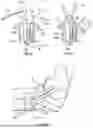 Fig. 07 - SUTURE LOCKING DEVICES FOR PERFORMING TENSIONABLE KNOTLESS SURGICAL PROCEDURES