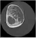 Fig. 01 - METHODS OF P21 SUPPRESSION FOR BONE REGENERATION AND HEALING