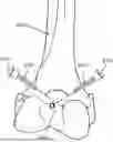 Fig. 01 - ALGORITHM-BASED OPTIMIZATION FOR KNEE ARTHROPLASTY PROCEDURES