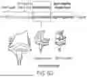 Fig. 15 - ALGORITHM-BASED OPTIMIZATION FOR KNEE ARTHROPLASTY PROCEDURES