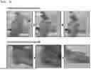 Fig. 09 - VASCULAR CLIP FOR BLOOD FLOW CONTROL