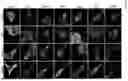 Fig. 04 - METHODS OF DIAGNOSING, DETERMINING THE PROGRESSION OF, AND TREATING A PROSTATE CANCER