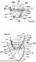 Fig. 06 - Corded Leaflet Free Edge Valve