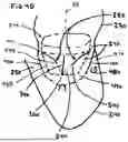 Fig. 07 - Corded Leaflet Free Edge Valve