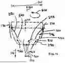 Fig. 15 - Corded Leaflet Free Edge Valve