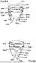 Fig. 16 - Corded Leaflet Free Edge Valve