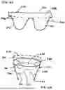 Fig. 17 - Corded Leaflet Free Edge Valve
