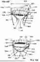 Fig. 19 - Corded Leaflet Free Edge Valve