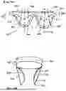 Fig. 20 - Corded Leaflet Free Edge Valve