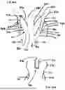 Fig. 23 - Corded Leaflet Free Edge Valve