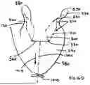 Fig. 24 - Corded Leaflet Free Edge Valve