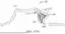 Fig. 25 - METHODS FOR DETERMINING ATTACHMENT PLACEMENT APPLIANCE GEOMETRY