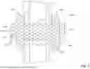 Fig. 04 - SYSTEMS AND METHODS MODIFYING TISSUE ADJACENT A STENT