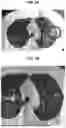 Fig. 04 - COMPOSITION AND METHODS FOR TREATMENT OR PROPHYLAXIS OF CORONAVIRUS AND CANCERS