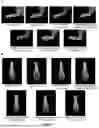 Fig. 06 - USE OF NAPHTHOQUINE PHOSPHATE IN PREPARATION OF A MEDICAMENT FOR TREATING AUTOIMMUNE DISEASES