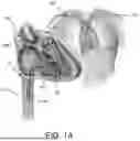 Fig. 02 - VENTRICULAR ASSIST SYSTEM AND METHOD OF TREATMENT OF CARDIOVASCULAR IMPAIRMENT