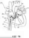 Fig. 03 - VENTRICULAR ASSIST SYSTEM AND METHOD OF TREATMENT OF CARDIOVASCULAR IMPAIRMENT