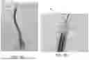 Fig. 10 - VENTRICULAR ASSIST SYSTEM AND METHOD OF TREATMENT OF CARDIOVASCULAR IMPAIRMENT