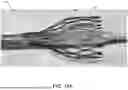 Fig. 24 - VENTRICULAR ASSIST SYSTEM AND METHOD OF TREATMENT OF CARDIOVASCULAR IMPAIRMENT