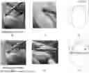 Fig. 01 - NAIL CARE METHOD USING NAIL BIT WITHOUT USING NIPPER