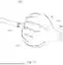 Fig. 11 - Ablation Catheters with Deployable Electrode Structures for Use in Ablation and Electrophysiological Mapping