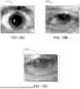 Fig. 20 - SYSTEMS FOR EYE TREATMENT