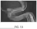 Fig. 14 - SYSTEMS AND METHODS FOR OCT-GUIDED TREATMENT OF A PATIENT