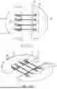 Fig. 11 - Closure Apparatuses and Methods for Ulcers and Irregular Skin Defects