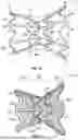 Fig. 03 - INTERATRIAL SHUNT HAVING PHYSIOLOGIC SENSOR