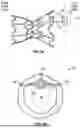 Fig. 06 - INTERATRIAL SHUNT HAVING PHYSIOLOGIC SENSOR