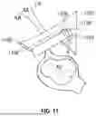 Fig. 14 - INTERATRIAL SHUNT HAVING PHYSIOLOGIC SENSOR