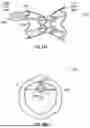 Fig. 16 - INTERATRIAL SHUNT HAVING PHYSIOLOGIC SENSOR