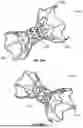Fig. 32 - INTERATRIAL SHUNT HAVING PHYSIOLOGIC SENSOR