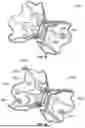 Fig. 35 - INTERATRIAL SHUNT HAVING PHYSIOLOGIC SENSOR