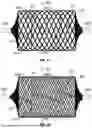 Fig. 15 - Vascular Occlusion Device