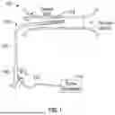 Fig. 02 - GUIDEWIRELESS SHOCK WAVE CATHETERS