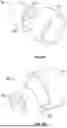 Fig. 15 - GUIDEWIRELESS SHOCK WAVE CATHETERS