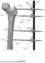 Fig. 03 - EXTERNAL FIXATOR ASSEMBLY