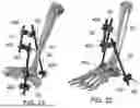Fig. 23 - EXTERNAL FIXATOR ASSEMBLY