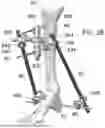 Fig. 28 - EXTERNAL FIXATOR ASSEMBLY