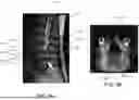 Fig. 04 - DEVICES, METHODS, AND SYSTEMS FOR ASSESSING SUITABILITY OF SPINAL IMPLANTS