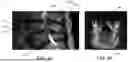 Fig. 05 - DEVICES, METHODS, AND SYSTEMS FOR ASSESSING SUITABILITY OF SPINAL IMPLANTS