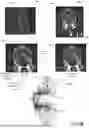 Fig. 11 - DEVICES, METHODS, AND SYSTEMS FOR ASSESSING SUITABILITY OF SPINAL IMPLANTS