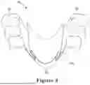 Fig. 04 - FORCE CONTROL, STOP MECHANISM, REGULATING STRUCTURE OF REMOVABLE ARCH ADJUSTMENT APPLIANCE