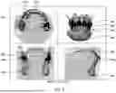 Fig. 05 - METHOD AND SYSTEM FOR DECOUPLING DENTAL ARCHES IN DENTAL SCAN DATA
