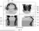 Fig. 06 - METHOD AND SYSTEM FOR DECOUPLING DENTAL ARCHES IN DENTAL SCAN DATA