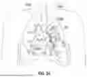 Fig. 16 - ROBOTIC SYSTEMS FOR DELIVERING ENDOBRONCHIAL IMPLANTS AND RELATED TECHNOLOGY