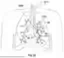 Fig. 37 - METHODS AND SYSTEMS FOR TREATING PULMONARY DISEASE